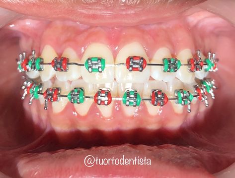 Braces Colors Christmas, Christmas Braces Color Ideas, Christmas Braces Colors, Christmas Braces, Brackets Ideas, Braces Colours, Braces Colors Combinations, Braces Ideas, Green Braces