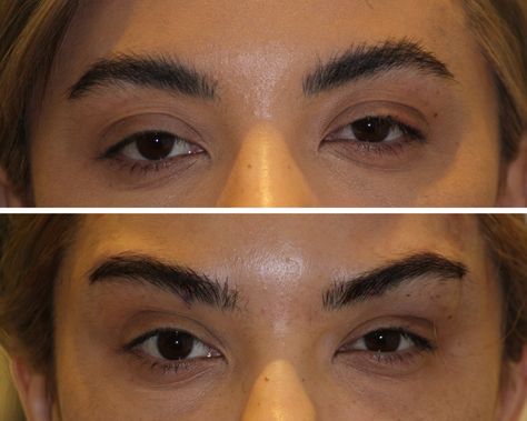 22 Eye Thread Lift, Eye Aesthetics, Thread Lift Face, Face Threading, Foxy Eyes, Face Lift Surgery, Train The Trainer, Thread Lift, Dr Mike