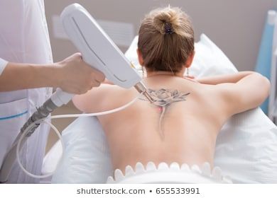 Tattoo Images, Stock Photos & Vectors | Shutterstock Surgeon Tattoo, Common Tattoos, Tattoo Removal Cost, No Regrets Tattoo, Laser Removal, Invisible Ink, Old Tattoos, Laser Tattoo, Laser Tattoo Removal