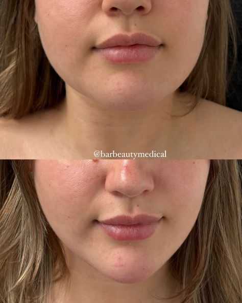 How amazing are these results?! This client came in with concerns about the shape of her face @aesthetic.nurse.rebecca used 1.5 ml of filler in her chin and the results speak for themselves 💉 Chin Filler, Aesthetic Nurse, Beige Nails, Face Aesthetic, Nose Job, Glow Up Tips, The Shape, Glow Up?, Surgery