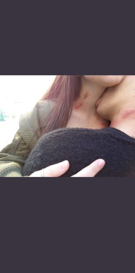 Back Of Neck Kiss, Hicks On Neck, Hickies Neck, Grunge Couple, Bed Bug Bites, I Want A Relationship, Boyfriend Pranks Pictures, Couple Goals Teenagers Pictures, Fit Couple