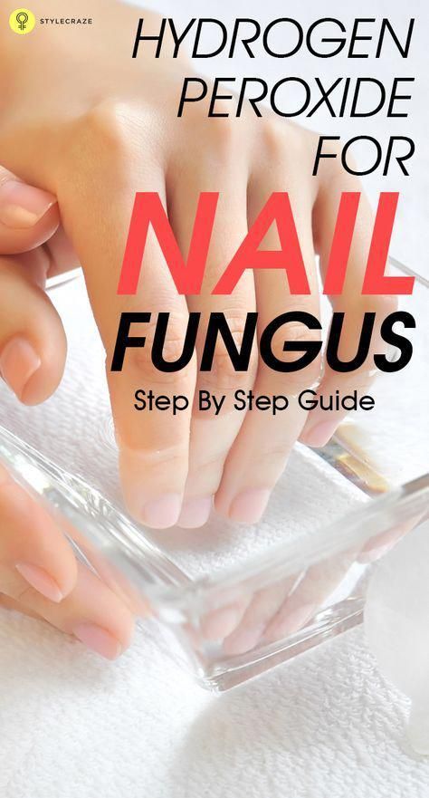 Nail Remedies, Nail Fungus Remedy, Nail Infection, Fungal Nail, Tongue Health, Ingrown Toe Nail, Toenail Fungus, Fitness Magazine, Hydrogen Peroxide