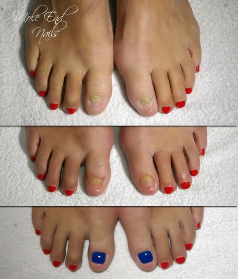 Toenail Reconstruction before and after #toenail #beforeafter Nail Tattoos, Summer Toes, Acrylic Toes, Acrylic Toe Nails, Nails Purple, Nail Tattoo, Nails Simple, Short Hair With Layers, Mole