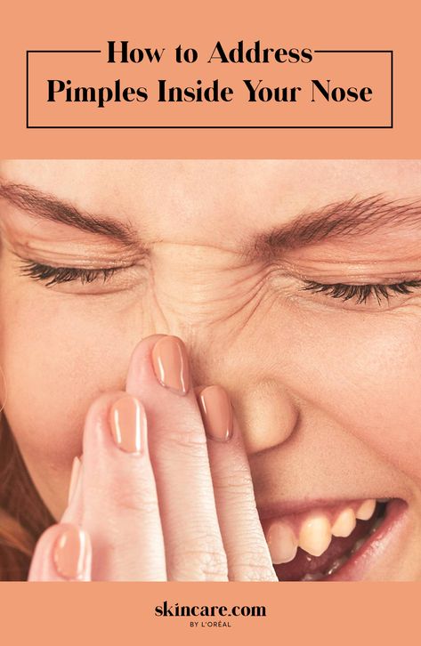 How to Get Rid of Pimples Inside Nose Sores Inside Nose, Pimple Under The Skin, Pimple Inside Nose, Nose Pimples, Back Acne Remedies, Blind Pimple, Pimples Under The Skin, Trigun Stampede, Pimples Remedies