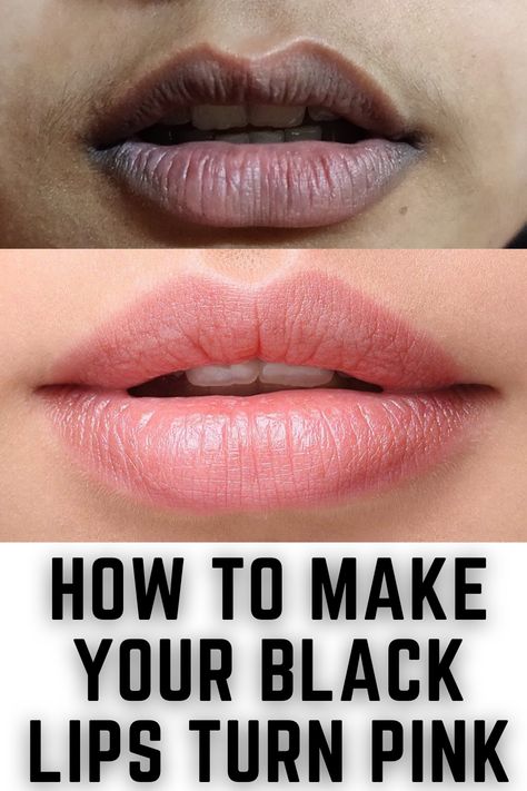 Remove Darkness Around Mouth, Darkness Around Mouth, Remedies For Dark Lips, Lighten Dark Lips, Natural Pink Lips, Lip Lightening, Mouth Lips, Lips Black, Hyper Pigmentation