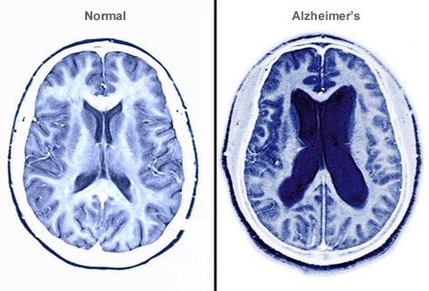 Diseases Pictures, Alzheimers Caregivers, Caregiver Burnout, Alzheimer Care, Brain Tissue, Brain Scan, Alzheimers Awareness, Disease Symptoms, Healing Touch