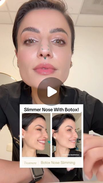 Enki Nichols | Lone Tree Aesthetics Med Spa on Instagram: "How I slim/sculpt my nose with Botox.
Here is a shorter version of my two previous educational videos regard nose tox. The number of Botox units required for each patient varies greatly on how large your muscle is, how strong it is, the position
 of your muscle, and other factors. Results can last up tô 4 months. #botox #nosetox #nosesculpt #droopynose #nurseinjector #coloradonurse #lonetreecolorado #educational #muscles" Botox Face Before And After, Botox Nose Before After, Nose Tip Lift Botox Before And After, Botox Jelly Roll Before And After, Botox Nose Tip Lift, Large Nose Beauty, Bunny Lines Botox Before And After, Botox Face Lift, Nose Botox Before And After