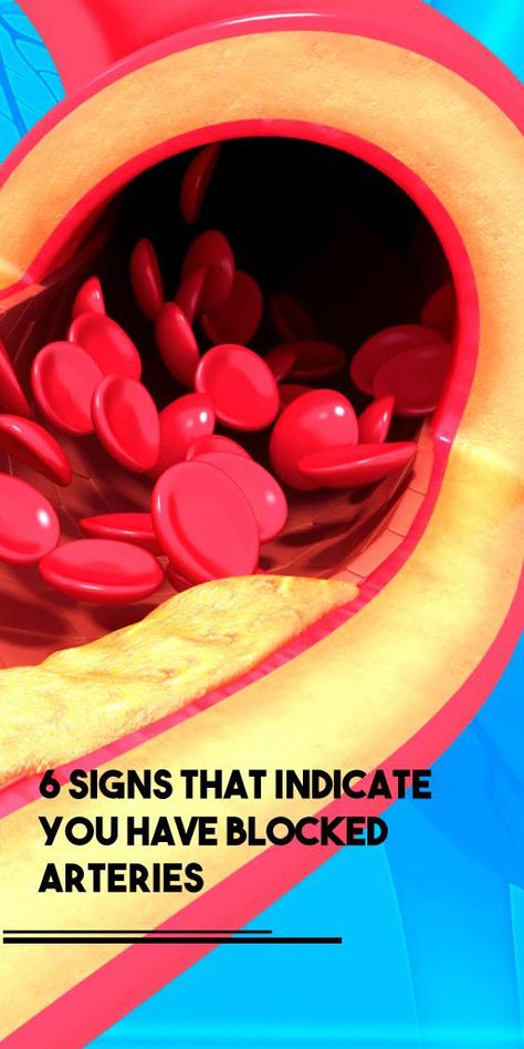 6 Signs That Indicate You Have Blocked Arteries Artery Cleanse, Clogged Arteries, Coronary Arteries, Creating A Newsletter, Daily Health Tips, Shortness Of Breath, Homemade Remedies, Healthy Eating Tips, Signs And Symptoms