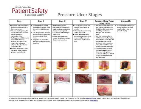 Pressure Ulcer Staging Guide Bowel Movement Chart, Pressure Ulcer Staging, Emt Study, Wound Care Nursing, Nurse Brain Sheet, Nursing School Inspiration, Pressure Ulcer, Subcutaneous Tissue, Nurse Study Notes