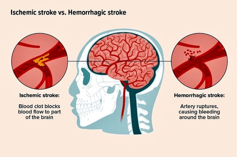 Understanding Stroke 🧠 Ischemic Vs Hemorrhagic Stroke💥 This is our new Account 🧑🏻‍⚕️old account was hacked ⚠️ Thank you for your support ❤️‍🩹 . . . . . . . . . . . . . . . . #futuredoctor #instagram #instagood #InstaFamous #TrendingNow #test #ViralContent #tiktok #foryou #mcqs #ExplorePage #goingviral #500k #100k #newyork #canda #usa #uk #usmle #plab #nle #amc #haad #foryou Ischemic Strokes, Types Of Strokes, Medical Study, Yoga Information, When To Plant Vegetables, Medical Procedures, Family Nurse Practitioner, Study Essentials, Severe Headache