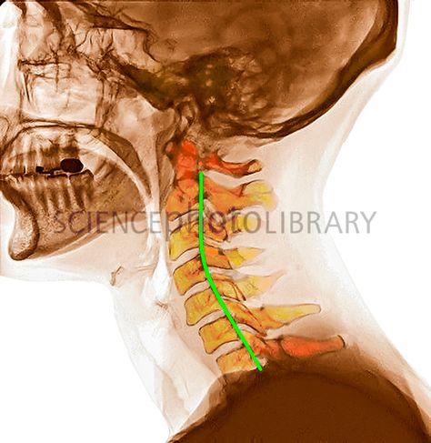 Curvature of the cervical spine. Coloured lateral X-ray of a human head and neck, showing the cervical spine with normal curvature. The front of the head is at left. The spinal cord, enclosed by the vertebrae, is highlighted in green within the backbone. The normal inward neck curvature is called cervical lordosis. Cervical Spine Anatomy, Cervical Lordosis, Spine Anatomy, Brain Nerves, X-ray Images, Cervical Spine, Human Head, Body Scanning, Spinal Cord