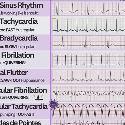 Surajit Tripura on Instagram: "Heart Rhythm | Health Sector" Heart Rythym Chart, Heart Rhythm Nursing Cheat Sheets, Irregular Heart Rhythms, Ekg Rhythms, Nursing Cheat Sheet, Nurse Study, Nursing Cheat, Heart Wave, Heart Rhythm