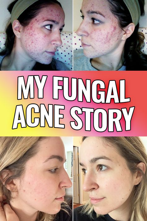 Nizoral For Fungal Acne, Yeast Acne, Fungal Acne Skin Care Routine, Forehead Breakout, Bacterial Acne, Expensive Products, Acne Diet, Fungal Acne, Healthy Healing