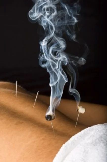 What is Moxibustion? - The Acupuncture Clinic Diy Massage Oil, Acupuncture Clinic, Back Pain Remedies, Neck Pain Relief, Migraine Headaches, Lower Back Pain, Massage Techniques, Low Back Pain, Back Pain Relief