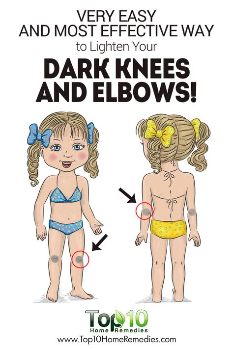 Very Easy And Most Effective Way to Lighten Your Dark Knees and Elbows! Lighten Dark Elbows, Dark Elbows And Knees, Dark Knees And Elbows, Dark Knees, Dark Elbows, Top 10 Home Remedies, Dark Underarms, Skin Remedies, Sagging Skin