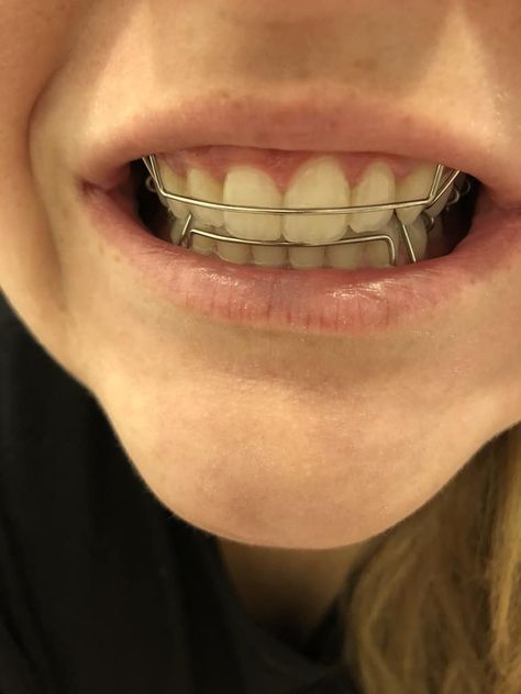 Braces Problems, Hawley Retainer, Braces Retainer, Retainer Teeth, Cute Braces Colors, Teeth Clip, Adult Braces, Braces Girls, Cute Braces