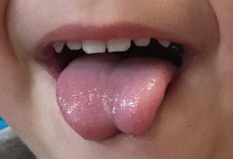 Tongue Tie: A Helpful Guide for Caregivers Feeding Therapy Activities, Feeding Therapy, Caregiver Resources, Why Questions, Laser Surgery, Tongue Health, Sinus Congestion, Tongue Tie, Lactation Consultant