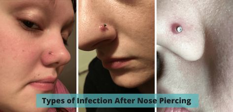 You really shouldn't have a hoop in it until it's healed, and it looks low quality.. Leave it alone and fingers crossed it should go down by itself.. Left alone they often go away over months.. Hormonal influences — can occur with oral contraceptive use and in 5% of pregnancies.You can look new details of Nose Piercing Granuloma by click this link : view details Granuloma Piercing, Infected Nose Piercing, Nose Piercing Tips, Nose Piercing Care, Nose Piercing Bump, Piercing Bump, Red Streaks, Dark Spots On Face, Womens Health Care