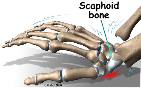 Scaphoid Fracture of the Wrist | eOrthopod.com Carpal Bones, Anatomy Arm, Scaphoid Fracture, Hand Fracture, Wrist Fracture, Pta Board, Anatomy 101, Fracture Healing, Outstretched Hand