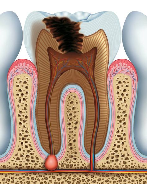 Tooth Caries, Abscess Tooth, Tooth Anatomy, Anatomy Stickers, Dental Assistant Study, Dental Images, Dental Posts, Remedies For Tooth Ache, Dental Posters