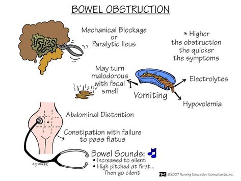 Bowel Obstruction can result from bowel wall swelling during severe hereditary angioedema abdominal attack. These attacks are incredibly painful. Hypovolemia may cause fainting, circulatory collapse. Severe attacks that are not treated with specific HAE medications for acute onset attacks, will last 2 to 7 days. HAE AAE IAE on Facebook Nutrition Nursing, Nursing Information, Nursing Board, Med Surg Nursing, Nursing Mnemonics, Surgical Nursing, Medical Surgical Nursing, Nursing School Survival, Nursing School Studying