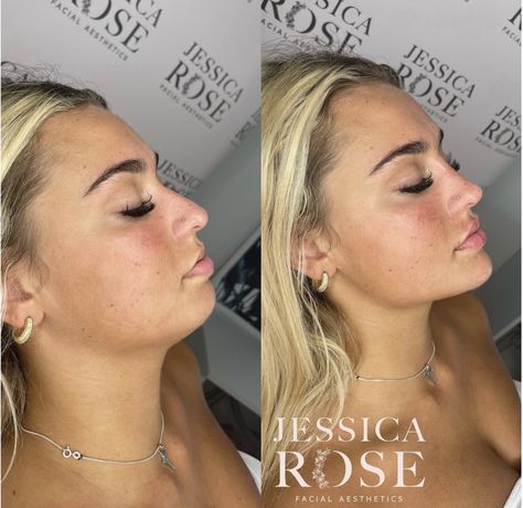 Jaw And Cheek Filler, Plastic Surgery Jawline, Chin Plastic Surgery Before After, Filler Face Contouring, Chin And Cheek Fillers, Cheek And Jaw Fillers, Chin Jaw Filler, Nose Job Filler, Cheek And Chin Filler