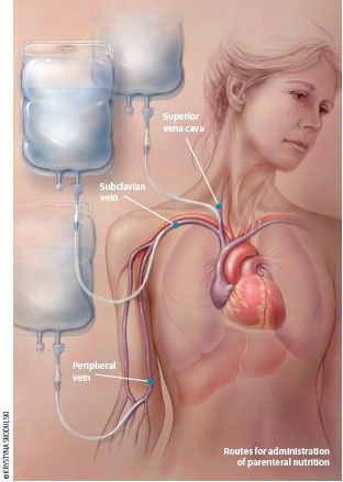 central line placement Parenteral Nutrition, Nursing Things, Nclex Questions, Nursing Information, Nursing Life, Nclex Exam, Central Line, Nursing Mnemonics, Nurse Rock