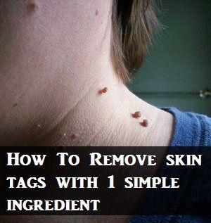 Skin tags are common, acquired benign skin growths that look like a small, soft balloons of hanging skin. They are harmless, but when most of us still want them to… Remove Skin Tags, Raw Ginger, Remove Skin Tags Naturally, Onion Juice, Skin Growths, Skin Tags, Organic Apple Cider, Cotton Balls, Homemade Remedies