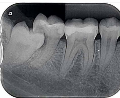 Dental Xrays, Dentistry Quotes, Happy Dental, Teeth Aesthetic, Dental Facts, Dental Humor, Wisdom Teeth, Long Square Acrylic Nails, Oral Health Care