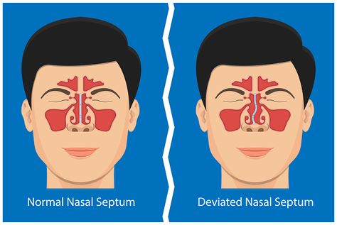 Do you have difficulty in breathing? Are you suffering from deviated septum? A Nose Septum Surgery can help you to find relief. Deviated Nasal Septum Surgery, Deviated Nasal Septum, Nasal Septum, Nose Septum, Perfect Nose, Nasal Cavity, Lungs Health, Nasal Passages, Emergency Plan