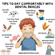 Braces Hygiene Tips, Dos And Donts With Braces, Brace Care Tips, List Of Things You Can’t Eat With Braces, How To Eat With Braces, Foods To Eat When You Get Braces, Braces Tips And Tricks, After Braces Tips, Foods You Cant Eat With Braces List