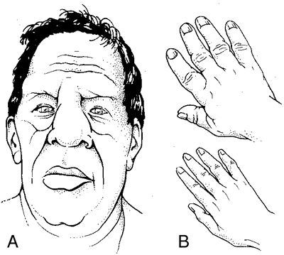 Multiple Endocrine Neoplasia, Paranasal Sinuses, Anterior Pituitary, Biology Worksheet, Medical Dictionary, Facial Structure, Brain Surgeon, Metabolic Disorders, Hormone Replacement