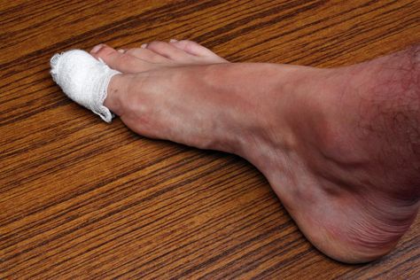 Toenail falling off: What to do, causes, and removal Toenail Fell Off, Nail Falling Off, Ingrown Toenail, Ingrown Toe Nail, Homemade Remedies, Natural Medicine, Home Health, Health Remedies, Natural Healing