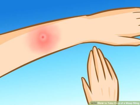 How to Take Care of a Wasp Sting: 8 Steps (with Pictures) Red Wasp Sting, Wasp Stings Relief, Bee Sting Relief, Wasp Sting Remedy, Hornet Sting, Wasp Sting, Remedies For Bee Stings, Red Wasps, Get Rid Of Wasps