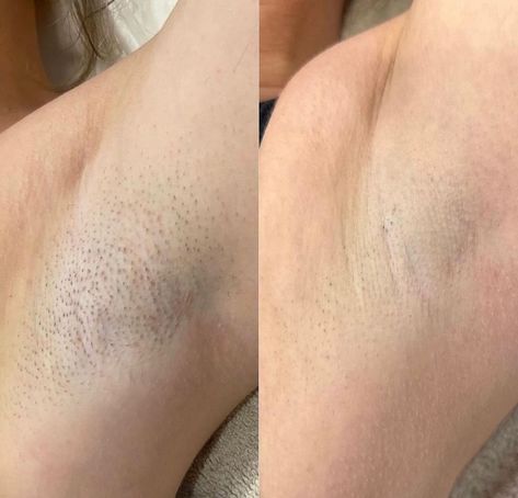 Just wanted to give a quick shout-out to one of our clients who’s seeing some amazing results from her laser hair removal treatments. After only 3 sessions, she’s noticing a huge difference – her skin is so much smoother, and she’s really excited about the progress🔥 She’s been able to cut down on her shaving routine, and she’s feeling more confident than ever. We can’t wait to see the final outcome after her next few sessions!  📲 (917) 701-0253  📞 (585)441-3838 Laser Hair Removal Room, Laser Hair Removal Results, Laser Hair Removal Face, Laser Hair Removal Cost, Hair Laser, Shaving Routine, Laser Removal, Black Friday Banner, Ipl Laser Hair Removal