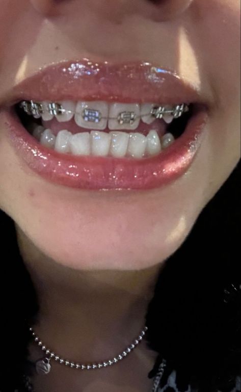 Braces Aethstetic, Braces On Top Teeth Only, Top Braces Only Teeth, Teeth Braces Aesthetic, Perfect Teeth Braces, Bottom Braces, Grey Braces, Braces Aesthetic, Braces Colours