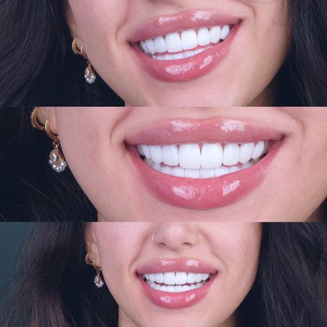 🌟 New Smile Alert! 🌟 Just transformed the smile with a ✨ Full Mouth Makeover ✨ featuring stunning Zirconia Crowns and dazzling Emax Veneers! 😁✨ Say goodbye to old woes and hello to my confident new grin! 🎉 🌈🦷📷 Zirconia Crowns Teeth, Overbite Correction, Emax Veneers, Clove Dental, Cosmetic Dentistry Veneers, Teeth Aesthetic, Cosmetic Dentistry Procedures, New Teeth, Strong Teeth