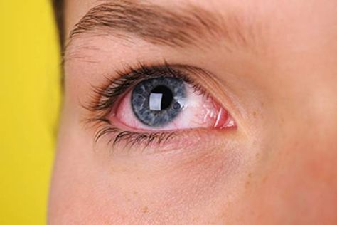 Ulcerative Colitis and Eye Health: What You Should Know | HealthCentral Eyeliner Glitter, Bloodshot Eyes, Eye Pain, Eye Infections, Watery Eyes, Itchy Eyes, Eyes Problems, Puffy Eyes, Dry Eyes