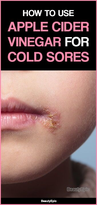 Cold Sore Scab, Cold Sore Remedy Fast, Cold Sore Remedy Overnight, Canker Sore Remedy, Cold Sore Relief, Get Rid Of Cold, Fever Blister, Cold Sores, Cold Medicine