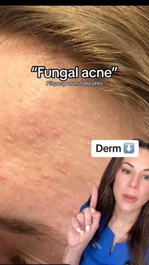 153K views · 3.9K reactions | The different types of “acne” Did you know not every breakout on the skin is traditional “acne” also known as acne vulgaris, a type of “bacterial” triggered acne? While this type of acne responds to traditional acne treatments like retinoids, benzoyl peroxide, and salicylic acid, some skin conditions may look like acne but respond to different treatments Pityrosporum folliculitis, affectionately known as fungal acne on the internet, is a less common skin condition that’s triggered by yeast and treated with anti-fungals. Perioral dermatitis on the other hand is more related to rosacea and is typically treated with ingredients like sulfur and azelaic acid. Questions about these different types of “acne”? Drop em below ⬇️ | Lindsey Zubritsky, MD, FAAD | derm Sudocrem Acne Before And After, Acne Photos, Different Types Of Acne, Fungal Acne, Forehead Acne, Teen Skincare, Bad Acne, Acne Vulgaris, Acne Treatments