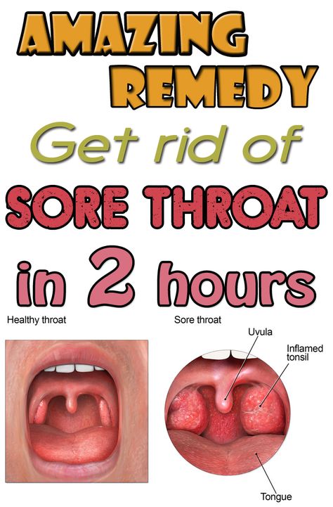 Amazing remedy. Get rid of sore throat in 2 hours - BeautyHealther.net Throat Remedies, Sore Throat Remedies, Strep Throat, Healthy Style, Holistic Remedies, Diet Vegetarian, Cold Remedies, Homemade Remedies, Natural Health Remedies