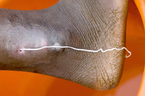 A patient with a guinea worm emerging, at the Savelugu Case Containment Center. Parasitic Worms, Little Dragon, Planets, The End, Health