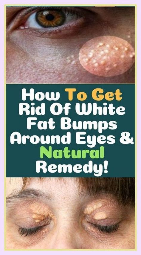 Smashing information and facts How To Remove Bumps On Face, How To Get Rid Of Bumps On Cheeks, How To Get Rid Of Little Bumps On Face, How To Get Rid Of Milia On Face, Bumps On Face, White Bumps On Face, Small White Bumps On Face, Under The Skin, White Skin