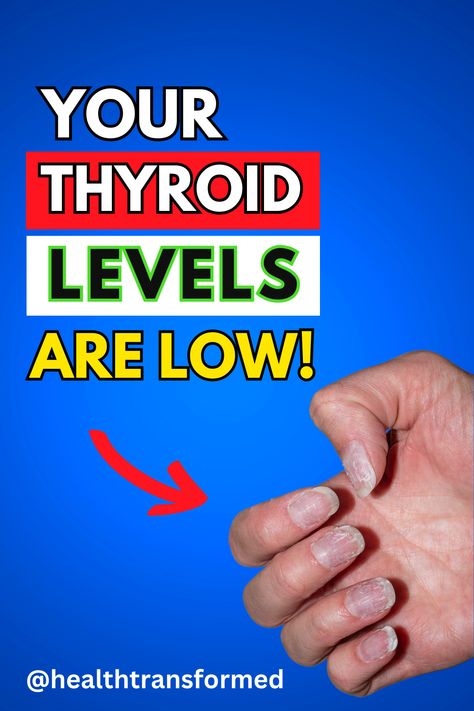 Strange Signs You Have Low Thyroid Levels - If you are wondering if you might have low thyroid hormone levels (hypothyroidism), check out this video on the strange signs and symptoms of low thyroid hormone levels! I'm on my journey to 1,000 subscribers on youtube so please watch the WHOLE video, hit subscribe, and drop a comment to let me know what you think! Optimal Thyroid Levels, Strange Signs, Low Thyroid Symptoms, Thyroid Levels, Overactive Thyroid, Low Thyroid, Thyroid Symptoms, Hashimotos Disease, Thyroid Hormone