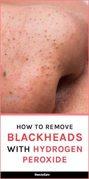 Remove Blackheads From Nose, How To Remove Blackheads, Blackhead Remover Diy, Black Head Remover Mask, To Remove Blackheads, Blackheads Removal, Cold Sores Remedies, Remove Blackheads, Natural Sleep Remedies