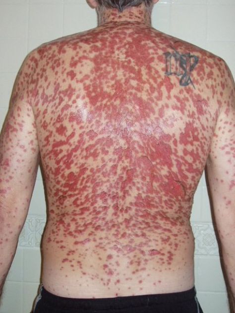 Stevens-Johnson Syndrome (SJS): rare & serious disorder of the skin & mucous membranes; usually a rxn to medication or an infection. Often begins with flu-like s/s, followed by a painful red/purplish rash that spreads & blisters. The top layer of the affected skin then dies & sheds; it is a medical emergency & requires hospitalization. Tx focuses on elimination of the underlying cause & controlling symptoms to minimize/prevent complications. Recovery takes weeks to months depending on severity. Stevens Johnson Syndrome, Steven Johnson Syndrome, Associates Degree In Nursing, Road Rash, Rare Disorders, Nurse Training, Study Stuff, Medical Emergency, Nursing Programs