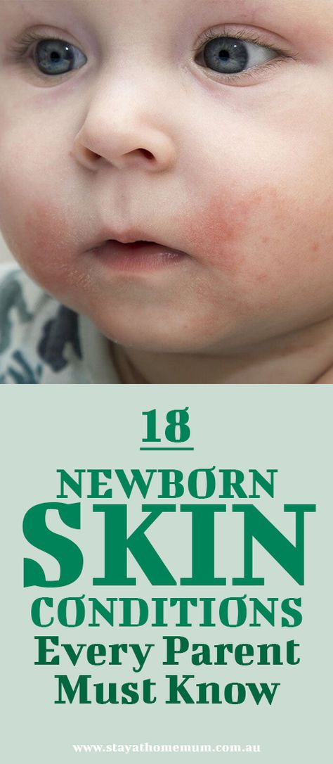 How do you know if your baby’s rashes are the usual and common rashes or those that needed to be seen by a doctor right away? Here are some newborn skin conditions that you need to know. Newborn Rash, Baby Skin Rash, Infant Development, Stay At Home Mum, Skin Bumps, Parents To Be, Skin Spots, Skin Redness, Baby Advice