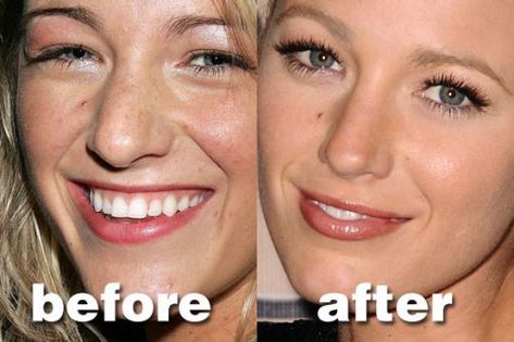 Nose job Blake Lively Nose, Nose Surgery Rhinoplasty, Celebrity Surgery, Rhinoplasty Nose Jobs, Plastic Surgery Photos, Rhinoplasty Before And After, Rhinoplasty Surgery, Best Plastic Surgeons, Facial Fillers