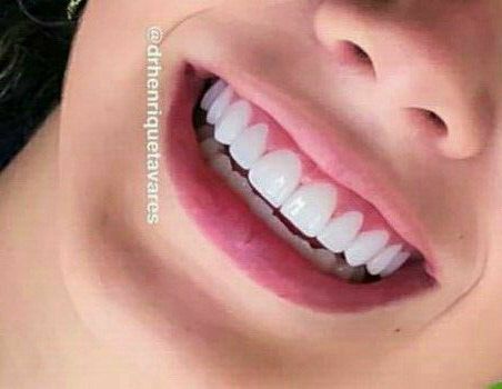 Teeth Makeover, Story Script, Teeth Aesthetic, Pretty Teeth, Bentuk Alis, Veneers Teeth, Beautiful Teeth, Straight Teeth, Perfect Teeth