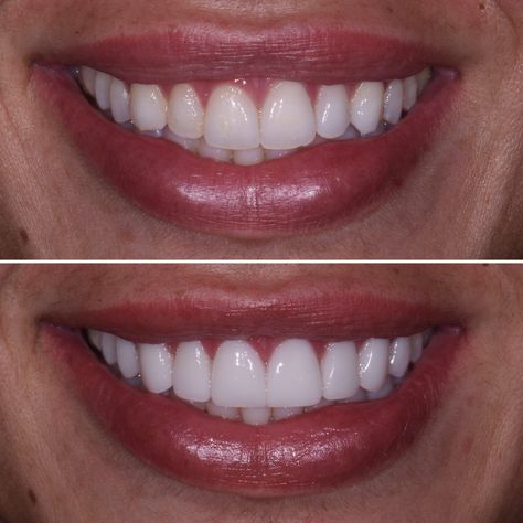 Porcelain Veneers Austin Yellow Teeth Remedy, Perfect Teeth Smile, Get Rid Of Yellow Teeth, Teeth Makeover, Dental Cover, Teeth Yellow, Celebrity Teeth, Teeth With Braces, Teeth Aesthetic